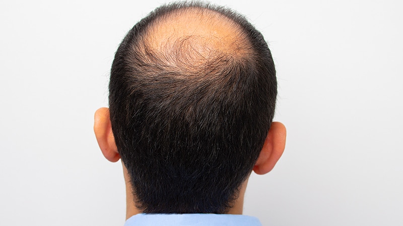 Alopecia Areata Linked to Mental Health Crisis