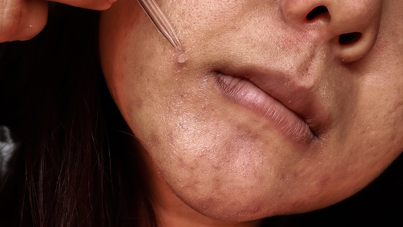 Third-Generation Progestins Linked to Lowest Melasma Risk