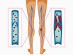 photo of deep vein thrombosis