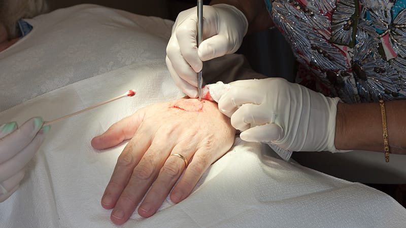 How Can Cancer Therapy Be Adjusted in Derm Surgery Patients?