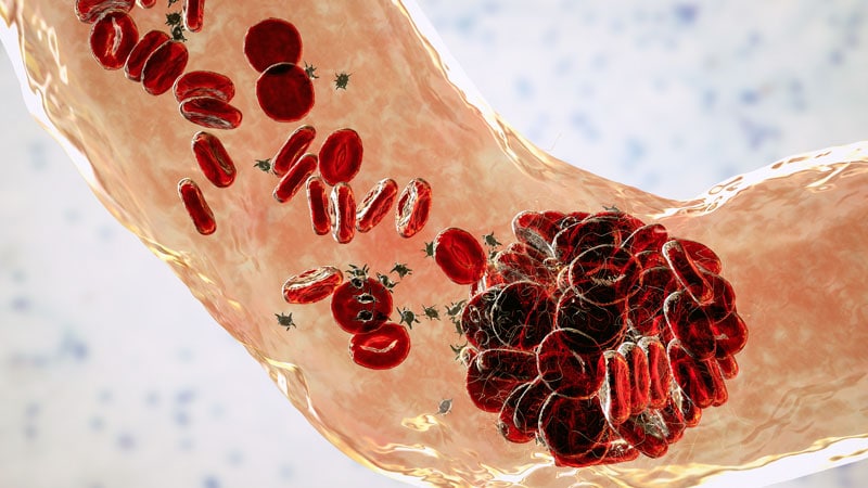 Chirurgie du cancer liée à un risque accru de thromboembolie veineuse
