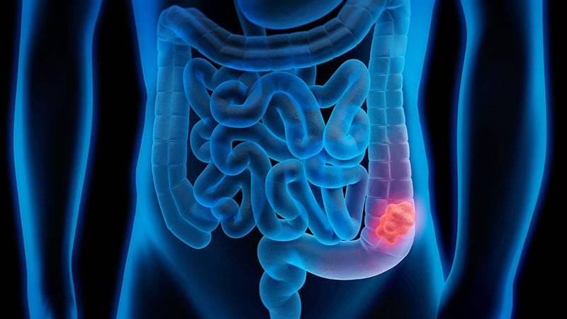 Can DNA Tests Promote Colorectal Cancer Screening?