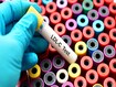 photo of ldl test