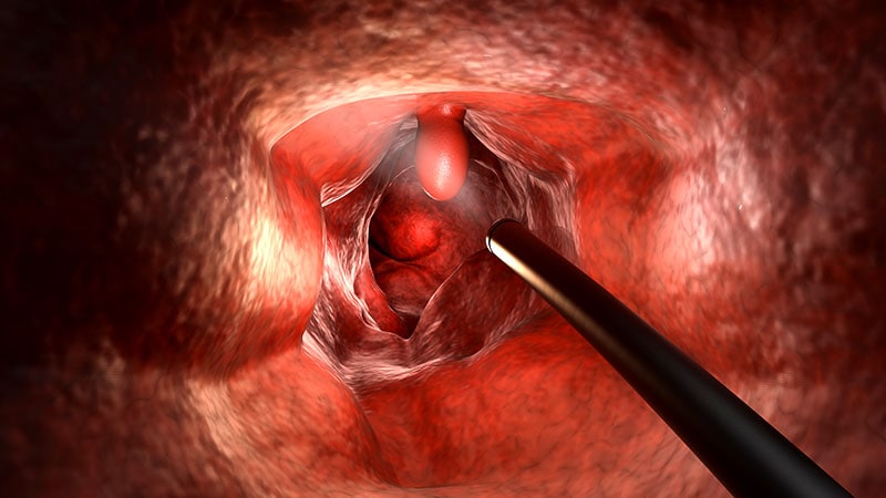 AI-Assisted Colonoscopy Linked to Increased Benign Lesion Removal