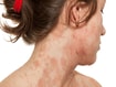 photo of severe atopic dermatitis