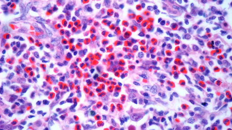 New Drug Combo Boosts PFS in Hodgkin Lymphoma