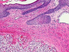 photo of renal cell carcinoma