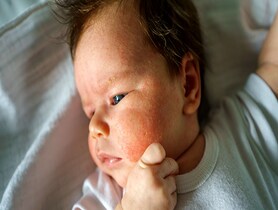 photo of atopic eczema