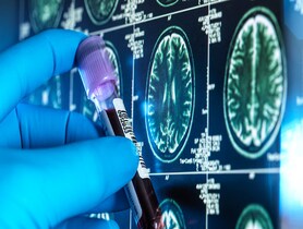 photo of Dementia research