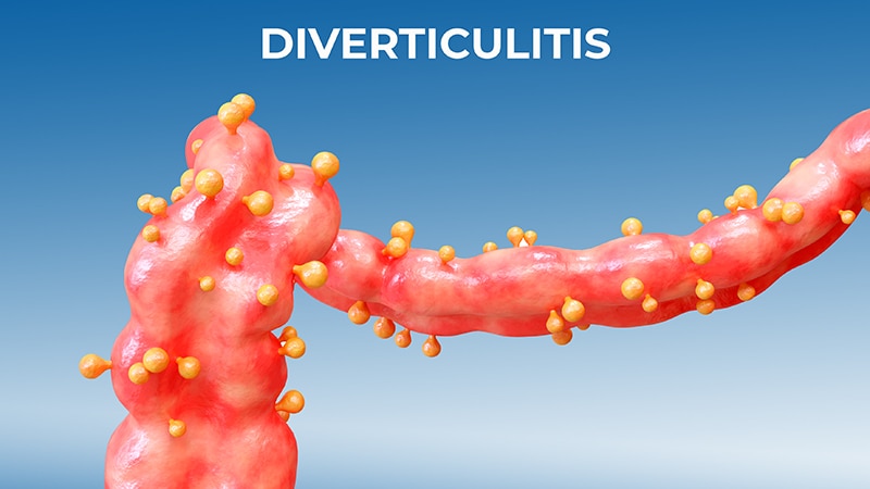 CT Scan and Antibiotic Utilization Developments for Diverticulitis