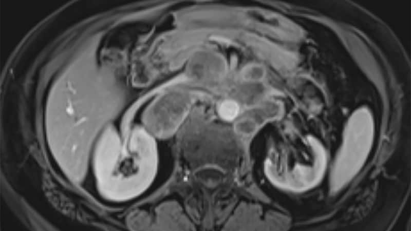 No Benefit with Pamrevlumab in Pancreatic Cancer