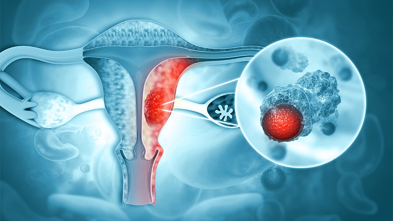 Can Minimally Invasive Surgery Match Open in Ovarian Cancer?