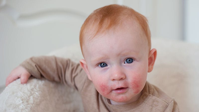 Is Atopic Dermatitis Linked to Cognitive Impairment Symptoms in Children?