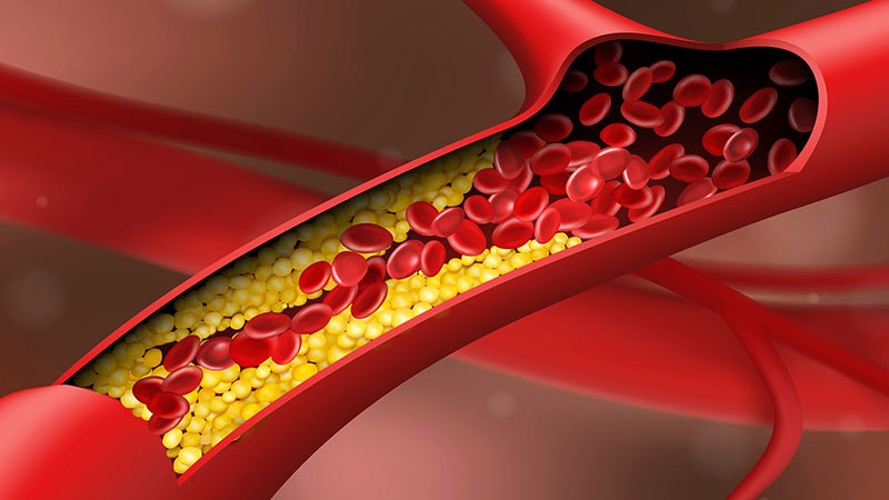 Pilot: OCT Parameter Tracks Atherosclerosis Progression