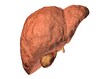photo of fibrotic liver