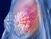 photo of breast cancer