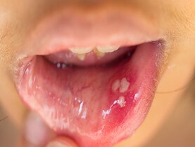 photo of mouth ulcer