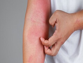 photo of Eczema allergy skin, atopic dermatitis