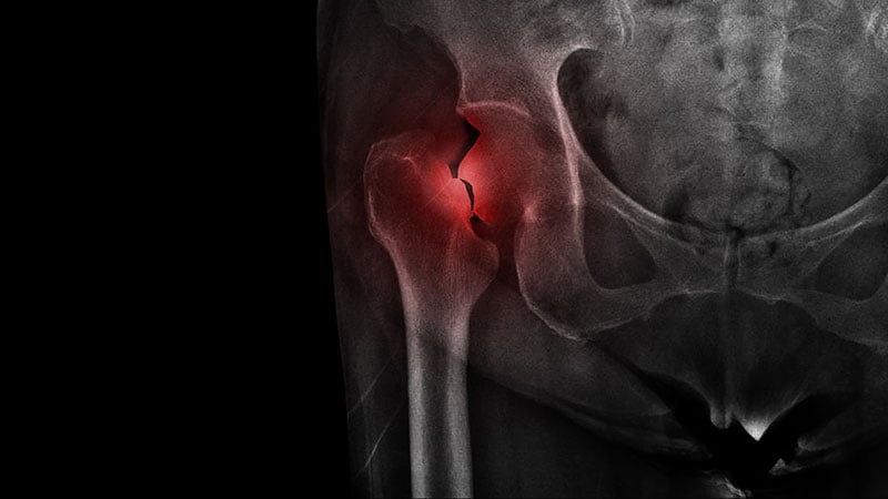 TNF Inhibitors Ward Off Fracture in Axial Spondyloarthritis