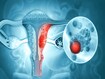 photo of Uterus cancer