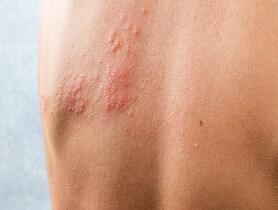 rash
