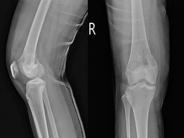 photo of X-ray knee joint (AP,LATERAL)Views a fema