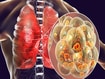 photo of Pneumococcal pneumonia. Computer illustra