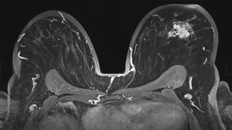 MRI Screen Cuts Breast Cancer Mortality Risk in BRCA1+ Women