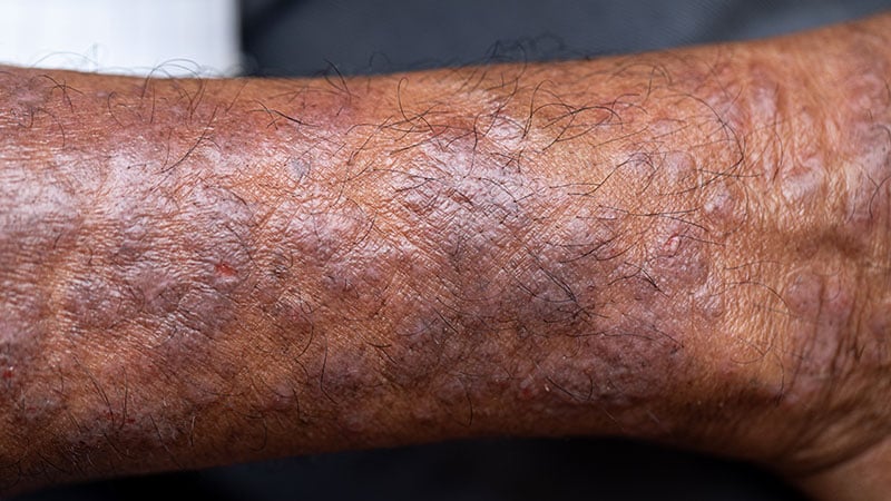 Lebrikizumab Found Effective for Patients With AD, SOC