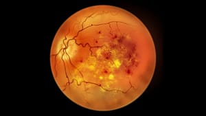 tirzepatide and retinopathy No Increased Retinopathy Risk Seen With Tirzepatide