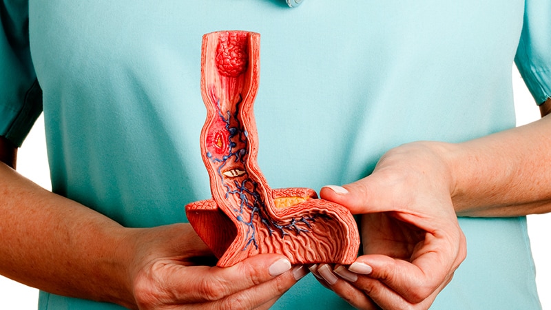 No EoE-Esophageal Cancer Link Found in Large US Study