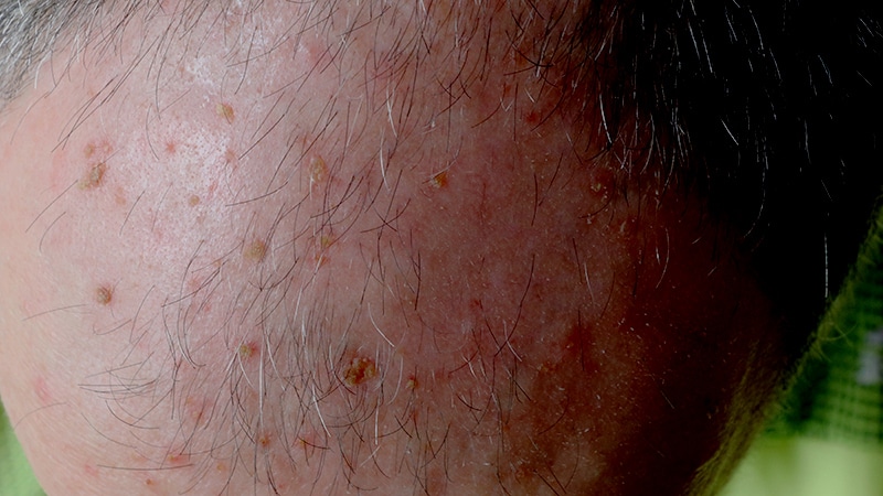 Tailor Actinic Keratosis Care for the Immunocompromised