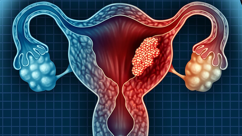 Skip Chemotherapy in Low-Grade Recurring Endometrial Cancer?