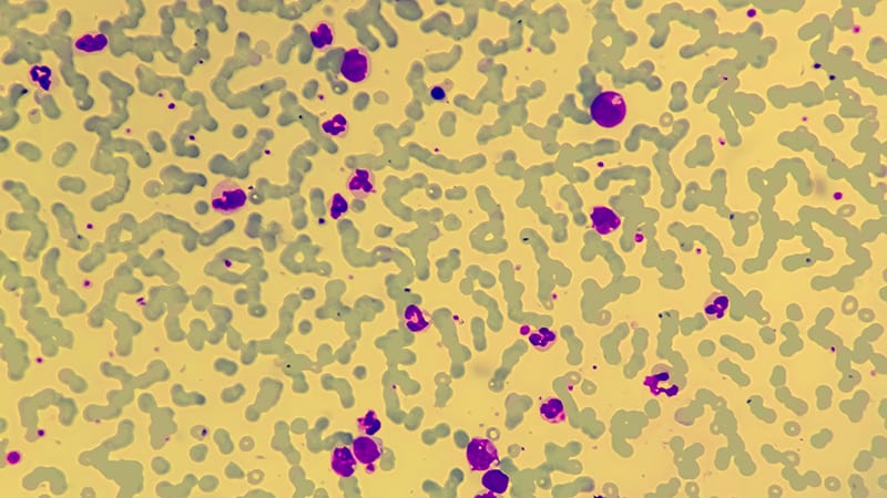 Stem Cell Transplant Linked to Longer Survival in CMML