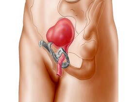 photo of urinary incontinence in females