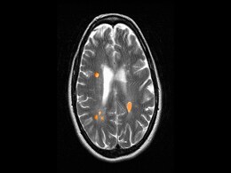 photo of MRI of multiple sclerosis