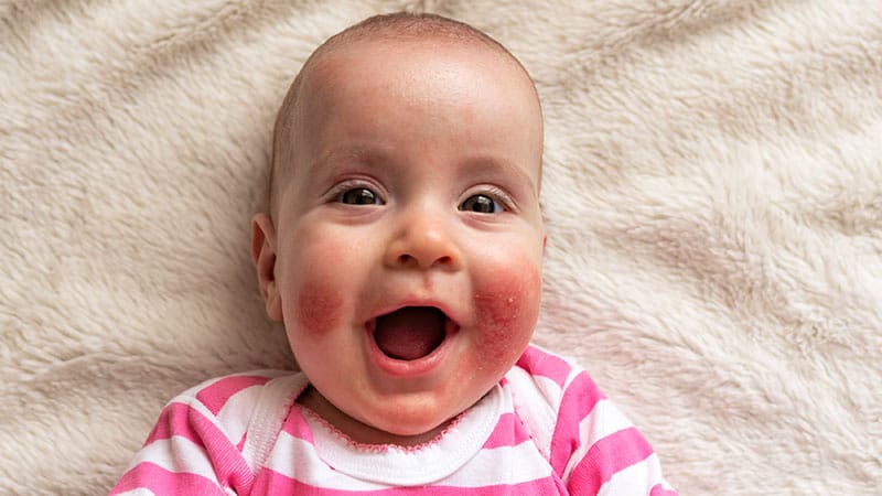 Risk Factors for Early Development of Food Allergies