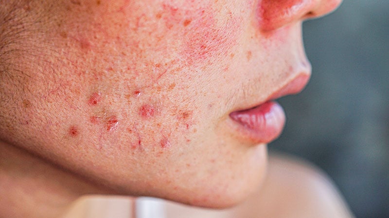 What you should know about JAKne – JAK inhibitor-associated acne