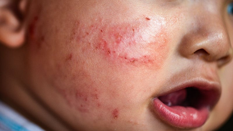 Food Allergies Tied to Increased Mental Health Risk in Kids