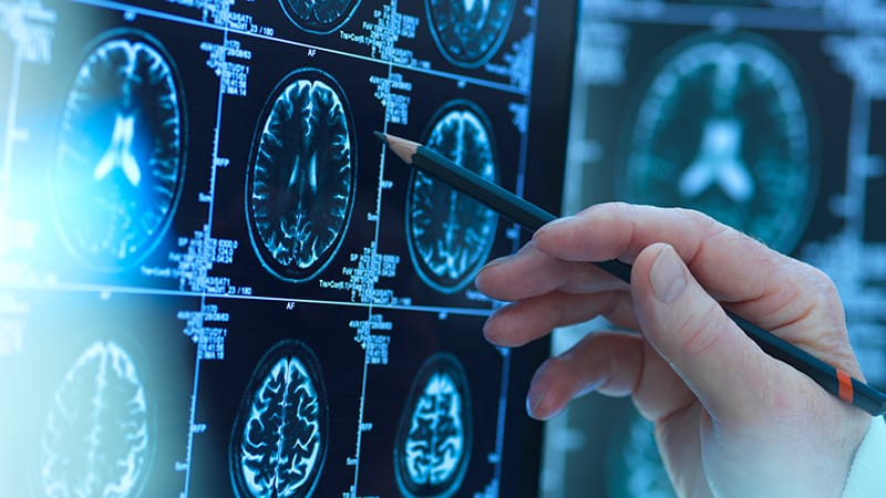 Timing of Neuropsychiatric Symptoms in Lupus Ranges Widely