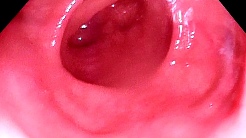 HSV-1 Enteritis in an Immunocompetent Man