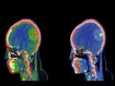 photo of Meningioma, CT scan