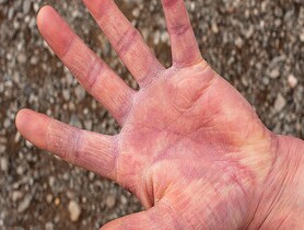 photo of Palm Wrinkles eczema