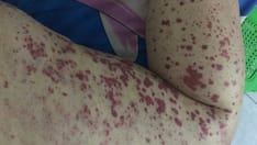 Severe Skin Symptoms in IgA Vasculitis Linked to Relapse