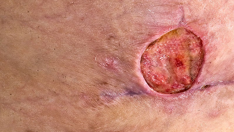 Most Chronic Wounds Not Managed by Dermatologists