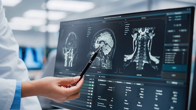 Beyond Amyloid: What’s in the Pipeline for Alzheimer’s?