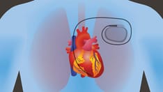 New Recommendations for Cardiac Devices