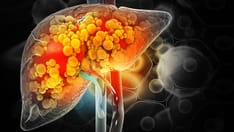 tirzepatide and mash Tirzepatide Shows Improvements in MASH Resolution, Fibrosis