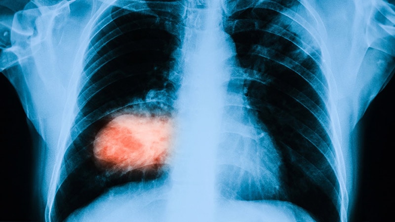 Comment un simple test d’urine pourrait révéler un cancer du poumon à un stade précoce