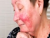photo of A senior woman with skin condition rosacea.
